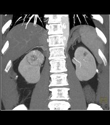 Vascular Right Renal Cell Carcinoma - CTisus CT Scan