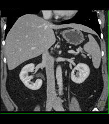 Vascular Right Renal Cell Carcinoma - CTisus CT Scan