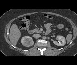 Vascular Right Renal Cell Carcinoma - CTisus CT Scan