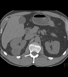 Renal Cell Carcinoma- See Full Sequence - CTisus CT Scan