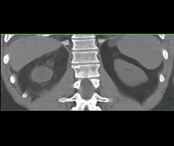 Renal Cell Carcinoma- See Full Sequence - CTisus CT Scan