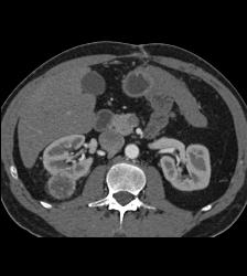 Renal Cell Carcinoma- See Full Sequence - CTisus CT Scan