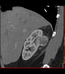 Renal Cell Carcinoma- See Full Sequence - CTisus CT Scan