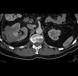 Pseudoaneurysm At Rf Site With Bleed - CTisus CT Scan