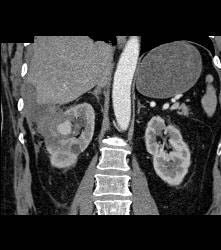 Pseudoaneurysm At Rf Site With Bleed - CTisus CT Scan