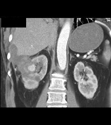 Pseudoaneurysm At Rf Site With Bleed - CTisus CT Scan