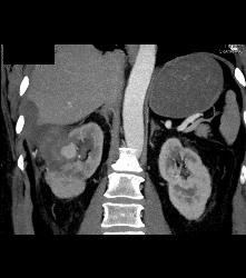 Pseudoaneurysm At Rf Site With Bleed - CTisus CT Scan