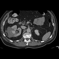 Pseudoaneurysm At Rf Site With Bleed - CTisus CT Scan