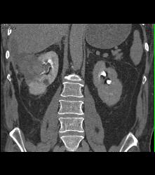 Pseudoaneurysm At Rf Site With Bleed - CTisus CT Scan