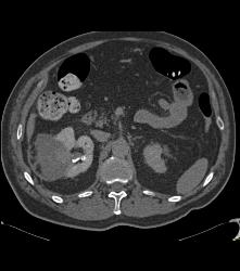 Pseudoaneurysm At Rf Site With Bleed - CTisus CT Scan