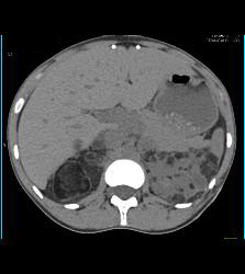 Bilateral Angiomyolipomas (AMLs) of Variable Shapes and Sizes - CTisus CT Scan