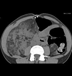 Bilateral Angiomyolipomas (AMLs) of Variable Shapes and Sizes - CTisus CT Scan