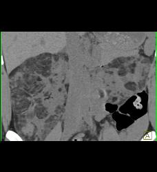 Bilateral Angiomyolipomas (AMLs) of Variable Shapes and Sizes - CTisus CT Scan