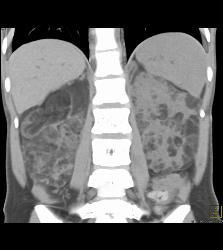 Bilateral Angiomyolipomas (AMLs) of Variable Shapes and Sizes - CTisus CT Scan