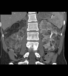 Bilateral Angiomyolipomas (AMLs) of Variable Shapes and Sizes - CTisus CT Scan