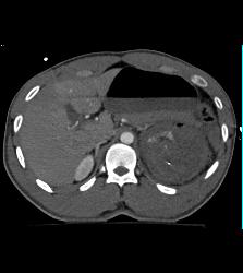 GSW With Level 5 Renal Injury - CTisus CT Scan