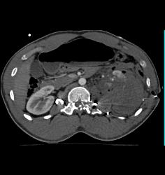 GSW With Level 5 Renal Injury - CTisus CT Scan