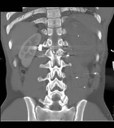 GSW With Level 5 Renal Injury - CTisus CT Scan