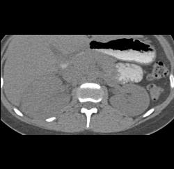 Acute Pyelonephritis - CTisus CT Scan