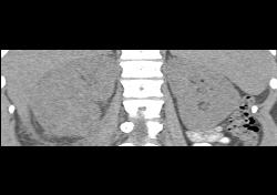 Acute Pyelonephritis - CTisus CT Scan