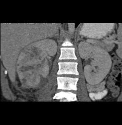 Acute Pyelonephritis - CTisus CT Scan