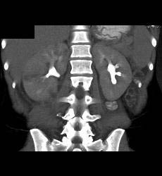 Acute Pyelonephritis - CTisus CT Scan