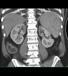 Acute Pyelonephritis - CTisus CT Scan