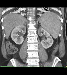 Acute Pyelonephritis - CTisus CT Scan