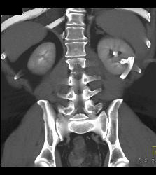 Acute Pyelonephritis - CTisus CT Scan