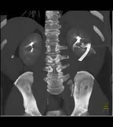 Acute Pyelonephritis - CTisus CT Scan