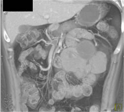 Germ Cell Tumor Obstructs the Left Kidney - CTisus CT Scan