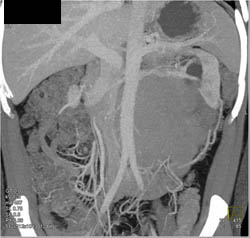 Germ Cell Tumor Obstructs the Left Kidney - CTisus CT Scan