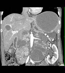 Metastatic Renal Cell Carcinoma - CTisus CT Scan