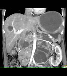 Metastatic Renal Cell Carcinoma - CTisus CT Scan