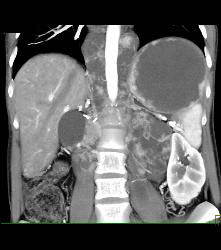 Metastatic Renal Cell Carcinoma - CTisus CT Scan