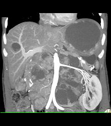 Metastatic Renal Cell Carcinoma - CTisus CT Scan