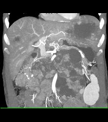 Metastatic Renal Cell Carcinoma - CTisus CT Scan