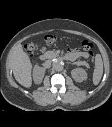 Patent Stents in Renal Arteries - CTisus CT Scan