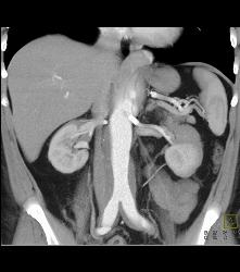 Patent Stents in Renal Arteries - CTisus CT Scan