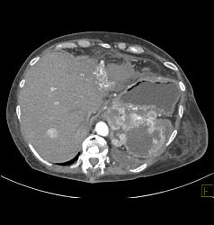 Recurrent Renal Cell Carcinoma - CTisus CT Scan