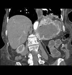 Recurrent Renal Cell Carcinoma - CTisus CT Scan