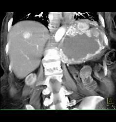 Recurrent Renal Cell Carcinoma - CTisus CT Scan