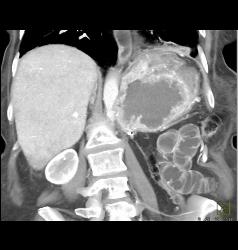 Recurrent Renal Cell Carcinoma - CTisus CT Scan