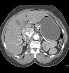 Clear Cell Renal Cell Carcinoma (RCC) With Involvement of Renal Vein and IVC Extending Into Right Atrium - CTisus CT Scan