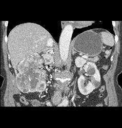 Clear Cell Renal Cell Carcinoma (RCC) With Involvement of Renal Vein and IVC Extending Into Right Atrium - CTisus CT Scan