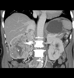 Clear Cell Renal Cell Carcinoma (RCC) With Involvement of Renal Vein and IVC Extending Into Right Atrium - CTisus CT Scan