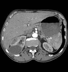 Subcapsular Hematoma - CTisus CT Scan