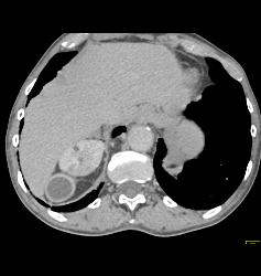 Subcapsular Hematoma - CTisus CT Scan