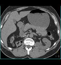 Post Right Nephrectomy - CTisus CT Scan