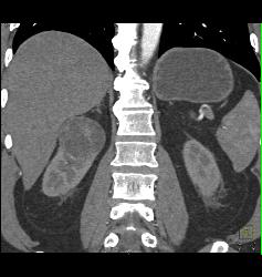 Cystic Renal Cell Carcinoma - CTisus CT Scan